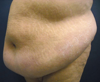 Chicago Abdominoplasty, Chicago tummy tuck, abdominoplasty photo, tummy tuck photo, tummy tuck picture, tummy tuck photograph, abdominoplasty picture, Chicago Tummy Tuck Photo, Chicago Tummy Tuck Picture, Chicago panniculectomy, panniculectomy